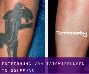 Entfernung von Tätowierungen in Golpejas