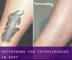 Entfernung von Tätowierungen in Gort