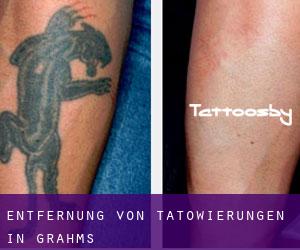 Entfernung von Tätowierungen in Grahms