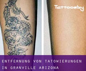 Entfernung von Tätowierungen in Granville (Arizona)