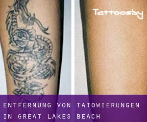 Entfernung von Tätowierungen in Great Lakes Beach