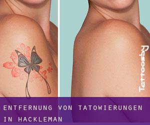 Entfernung von Tätowierungen in Hackleman