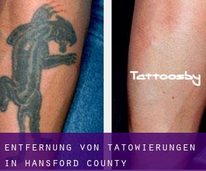 Entfernung von Tätowierungen in Hansford County
