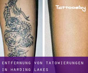 Entfernung von Tätowierungen in Harding Lakes