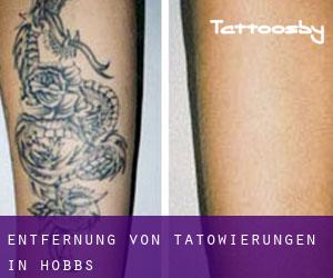 Entfernung von Tätowierungen in Hobbs