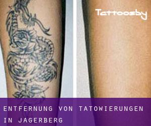 Entfernung von Tätowierungen in Jagerberg