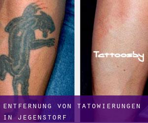 Entfernung von Tätowierungen in Jegenstorf