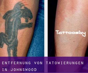 Entfernung von Tätowierungen in Johnswood