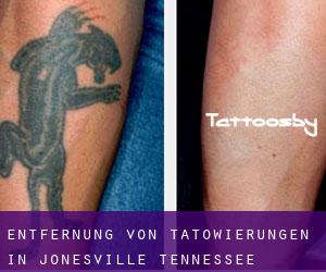 Entfernung von Tätowierungen in Jonesville (Tennessee)