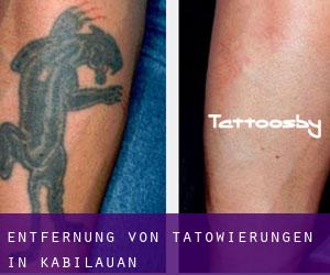 Entfernung von Tätowierungen in Kabilauan