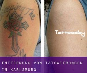 Entfernung von Tätowierungen in Karlsburg
