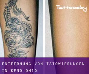 Entfernung von Tätowierungen in Keno (Ohio)