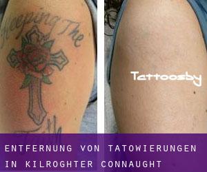 Entfernung von Tätowierungen in Kilroghter (Connaught)