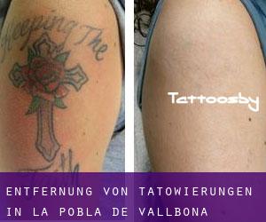 Entfernung von Tätowierungen in La Pobla de Vallbona