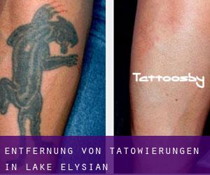 Entfernung von Tätowierungen in Lake Elysian