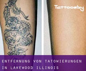 Entfernung von Tätowierungen in Lakewood (Illinois)