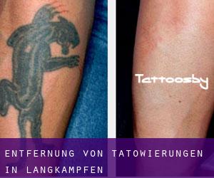 Entfernung von Tätowierungen in Langkampfen