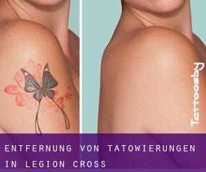 Entfernung von Tätowierungen in Legion Cross