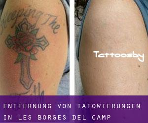 Entfernung von Tätowierungen in les Borges del Camp