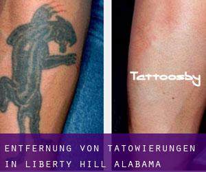 Entfernung von Tätowierungen in Liberty Hill (Alabama)
