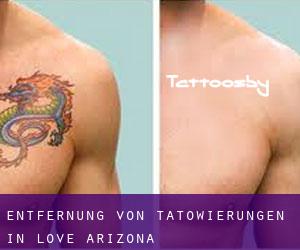 Entfernung von Tätowierungen in Love (Arizona)