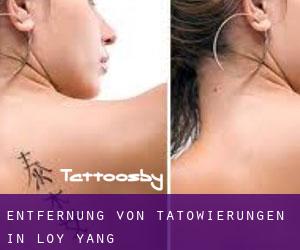 Entfernung von Tätowierungen in Loy Yang