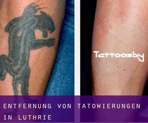 Entfernung von Tätowierungen in Luthrie