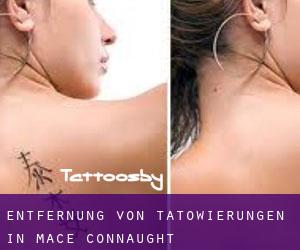 Entfernung von Tätowierungen in Mace (Connaught)