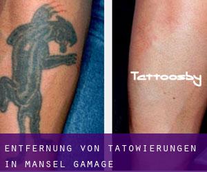 Entfernung von Tätowierungen in Mansel Gamage