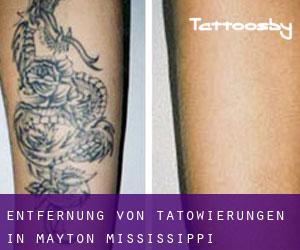 Entfernung von Tätowierungen in Mayton (Mississippi)