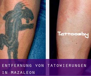 Entfernung von Tätowierungen in Mazaleón