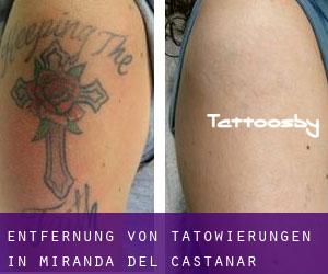 Entfernung von Tätowierungen in Miranda del Castañar