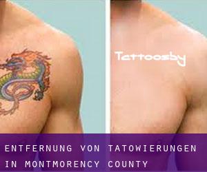 Entfernung von Tätowierungen in Montmorency County