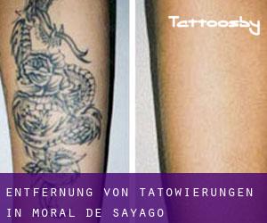 Entfernung von Tätowierungen in Moral de Sayago