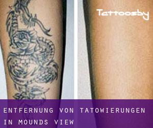 Entfernung von Tätowierungen in Mounds View