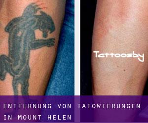 Entfernung von Tätowierungen in Mount Helen