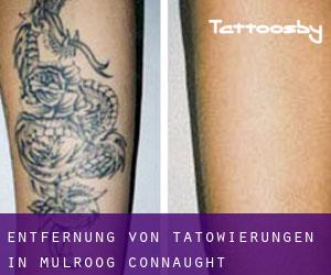 Entfernung von Tätowierungen in Mulroog (Connaught)