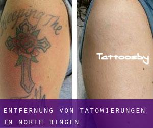 Entfernung von Tätowierungen in North Bingen