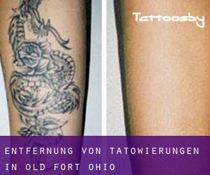 Entfernung von Tätowierungen in Old Fort (Ohio)