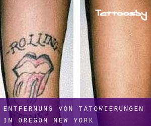 Entfernung von Tätowierungen in Oregon (New York)