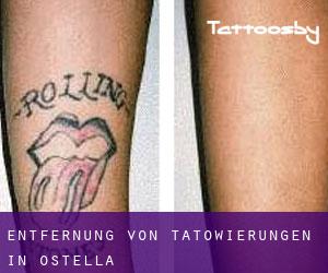 Entfernung von Tätowierungen in Ostella