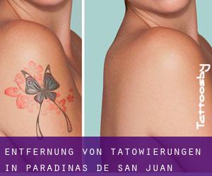 Entfernung von Tätowierungen in Paradinas de San Juan