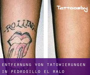 Entfernung von Tätowierungen in Pedrosillo el Ralo