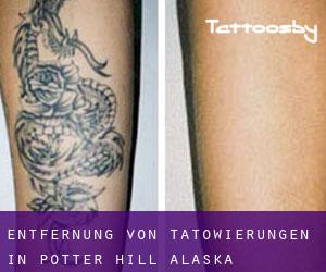 Entfernung von Tätowierungen in Potter Hill (Alaska)