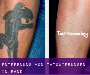 Entfernung von Tätowierungen in Rand