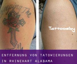 Entfernung von Tätowierungen in Rhinehart (Alabama)