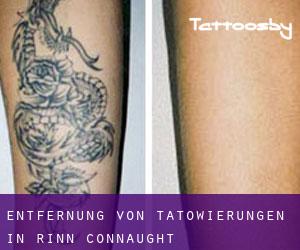 Entfernung von Tätowierungen in Rinn (Connaught)