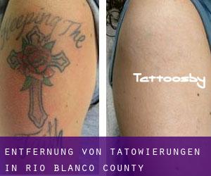 Entfernung von Tätowierungen in Rio Blanco County