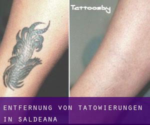 Entfernung von Tätowierungen in Saldeana