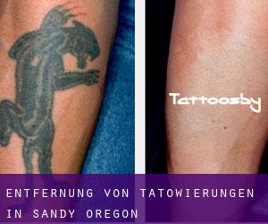 Entfernung von Tätowierungen in Sandy (Oregon)